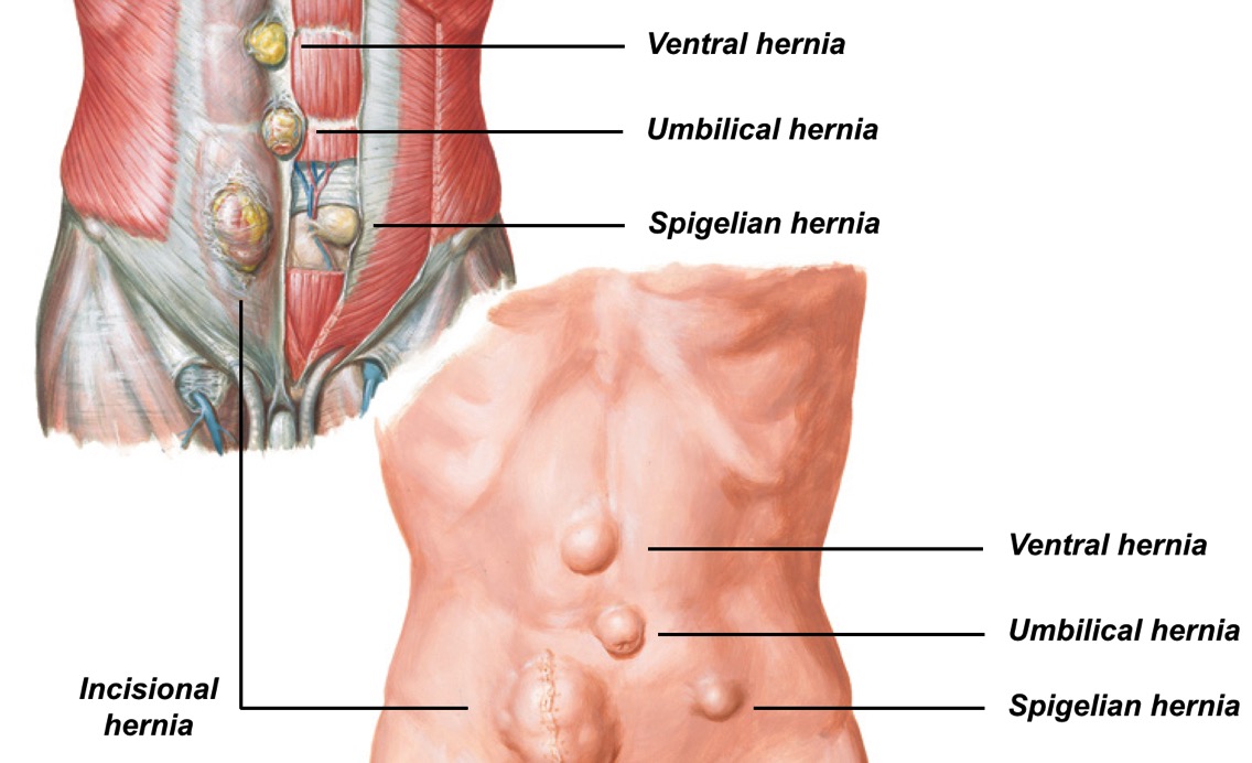 Hernia